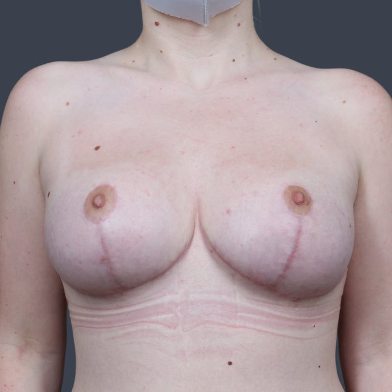 Breast Reduction Before & After Gallery - Patient 118917 - Image 2