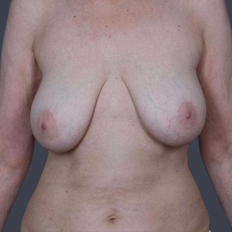 Breast Reduction Before & After Gallery - Patient 107304 - Image 1