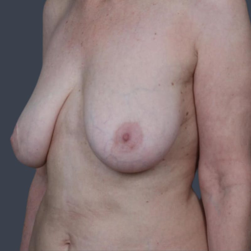 Breast Reduction Before & After Gallery - Patient 107304 - Image 3