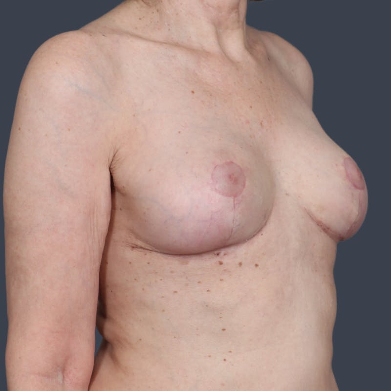 Breast Reduction Before & After Gallery - Patient 107304 - Image 6