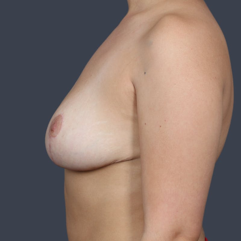 Breast Reduction Before & After Gallery - Patient 426242 - Image 6