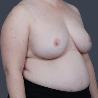 Breast Reduction Before & After Gallery - Patient 425208 - Image 4