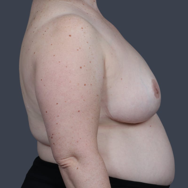 Breast Reduction Before & After Gallery - Patient 425208 - Image 6