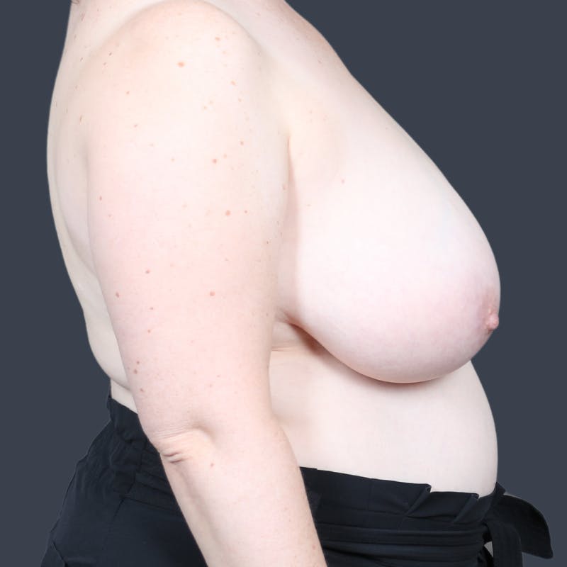 Breast Reduction Before & After Gallery - Patient 425208 - Image 5