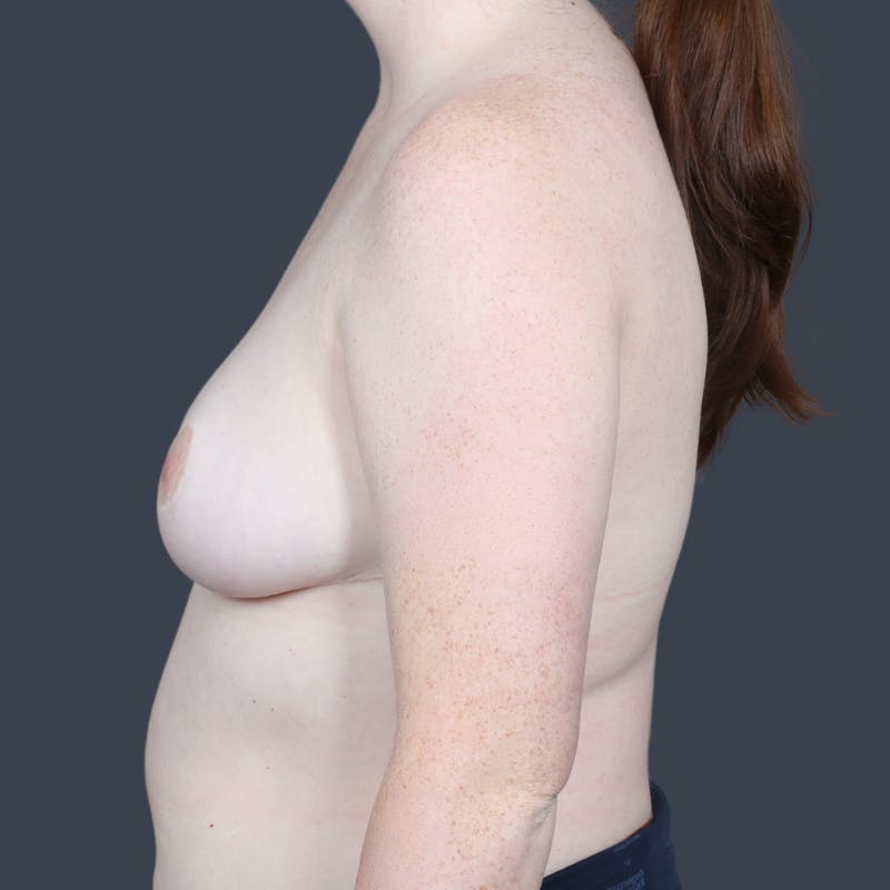 Breast Reduction Before & After Gallery - Patient 362499 - Image 6