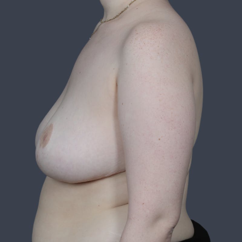 Breast Reduction Before & After Gallery - Patient 374068 - Image 6