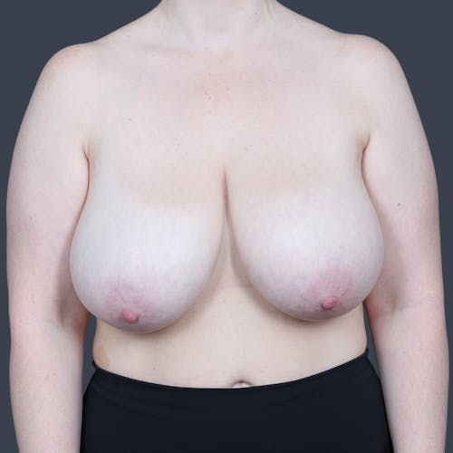 Before procedure image for Breast Reduction