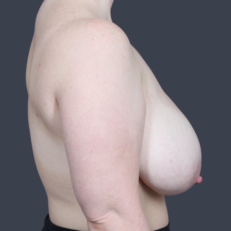 Breast Reduction Before & After Gallery - Patient 397944 - Image 5