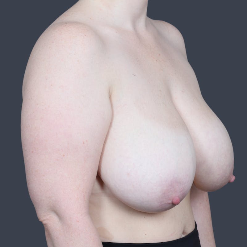 Breast Reduction Before & After Gallery - Patient 397944 - Image 3