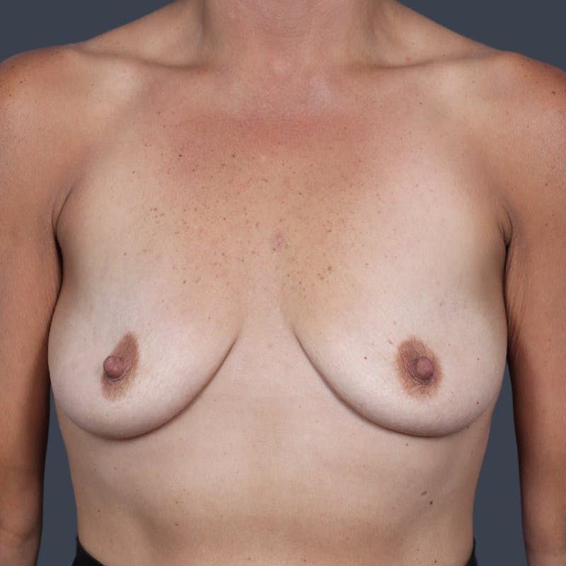 Breast Augmentation Before & After Gallery - Patient 647424 - Image 1