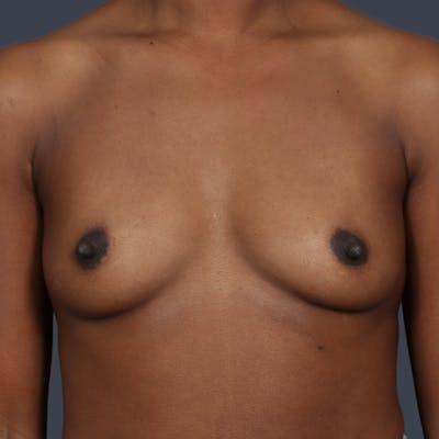 Breast Augmentation Before & After Gallery - Patient 513858 - Image 1