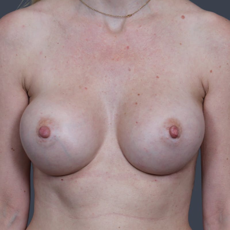 Breast Augmentation Before & After Gallery - Patient 256240 - Image 2