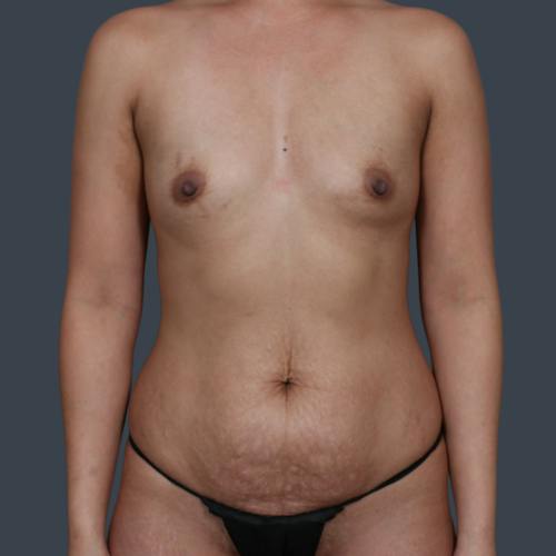 Before procedure image for Mommy Makeover