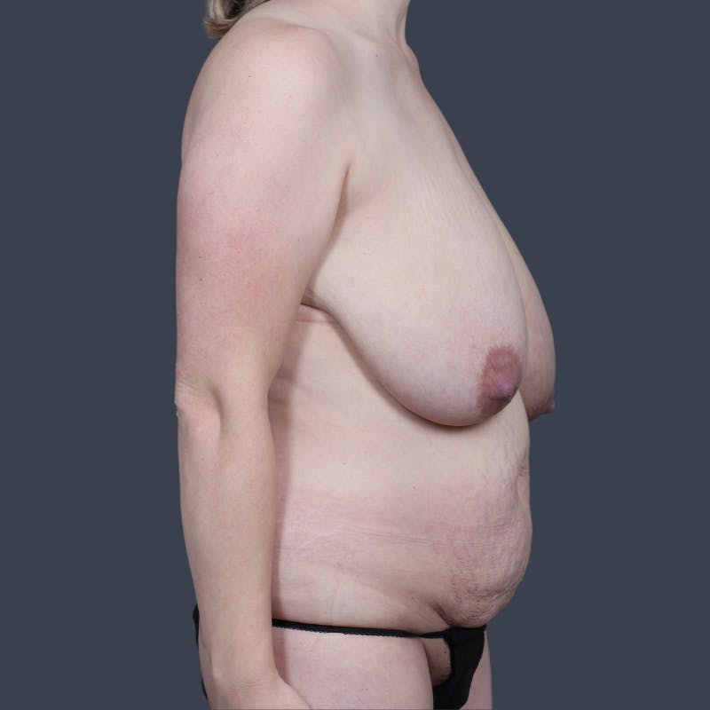 Mommy Makeover Before & After Gallery - Patient 403862 - Image 5