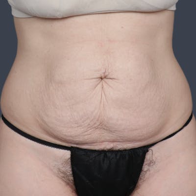 Abdominoplasty / Tummy Tuck Before & After Gallery - Patient 166945 - Image 1