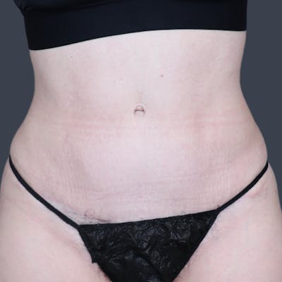 Abdominoplasty / Tummy Tuck Before & After Gallery - Patient 166945 - Image 2