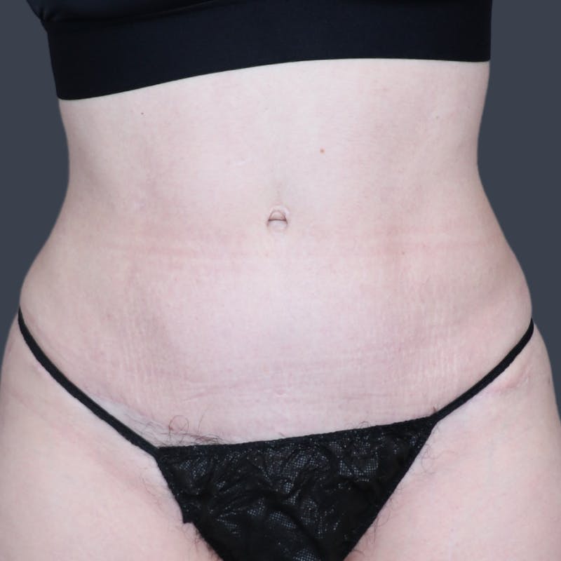 Abdominoplasty / Tummy Tuck Before & After Gallery - Patient 166945 - Image 2