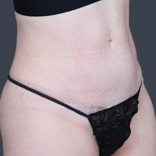 Abdominoplasty / Tummy Tuck Before & After Gallery - Patient 166945 - Image 4