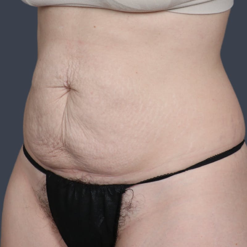 Abdominoplasty / Tummy Tuck Before & After Gallery - Patient 166945 - Image 5