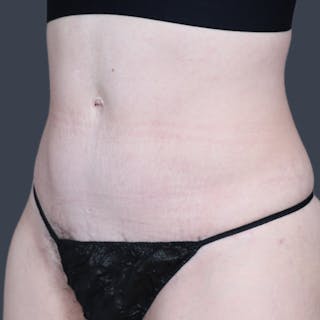 Abdominoplasty / Tummy Tuck Before & After Gallery - Patient 166945 - Image 6