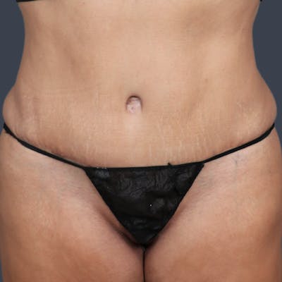 Abdominoplasty / Tummy Tuck Before & After Gallery - Patient 973942 - Image 2