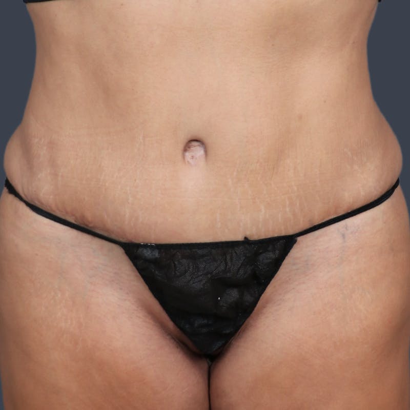 Abdominoplasty / Tummy Tuck Before & After Gallery - Patient 973942 - Image 2