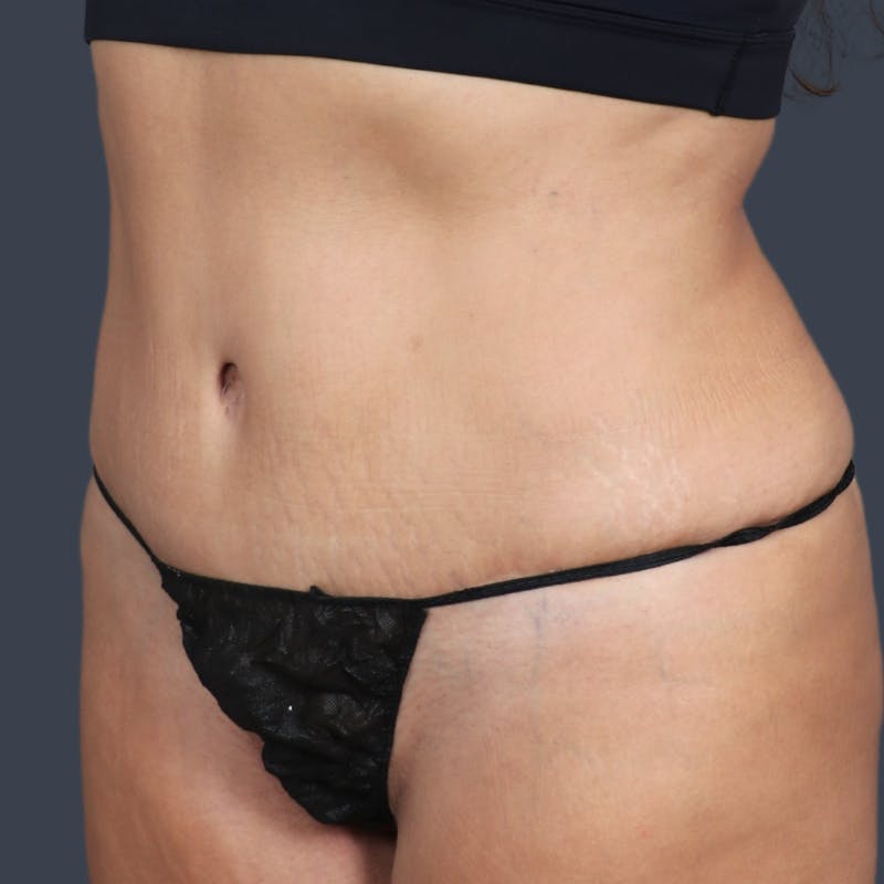 Abdominoplasty / Tummy Tuck Before & After Gallery - Patient 973942 - Image 6