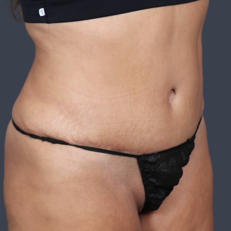 Abdominoplasty / Tummy Tuck Before & After Gallery - Patient 973942 - Image 4