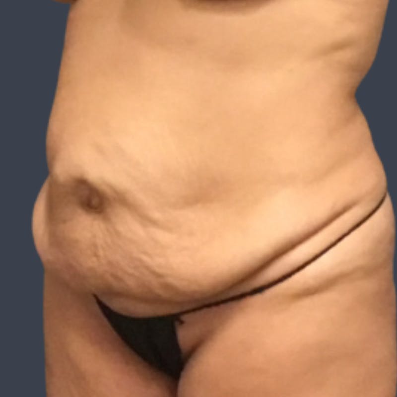 Abdominoplasty / Tummy Tuck Before & After Gallery - Patient 973942 - Image 5