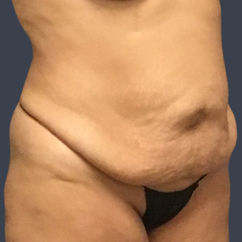 Abdominoplasty / Tummy Tuck Before & After Gallery - Patient 973942 - Image 3