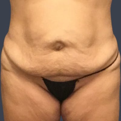 Abdominoplasty / Tummy Tuck Before & After Gallery - Patient 973942 - Image 1