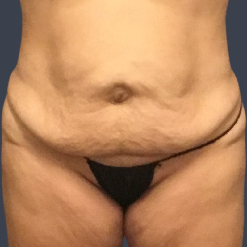 Abdominoplasty / Tummy Tuck Before & After Gallery - Patient 973942 - Image 1