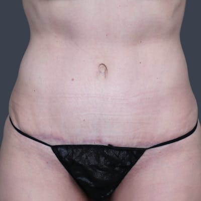 Abdominoplasty / Tummy Tuck Before & After Gallery - Patient 414583 - Image 2