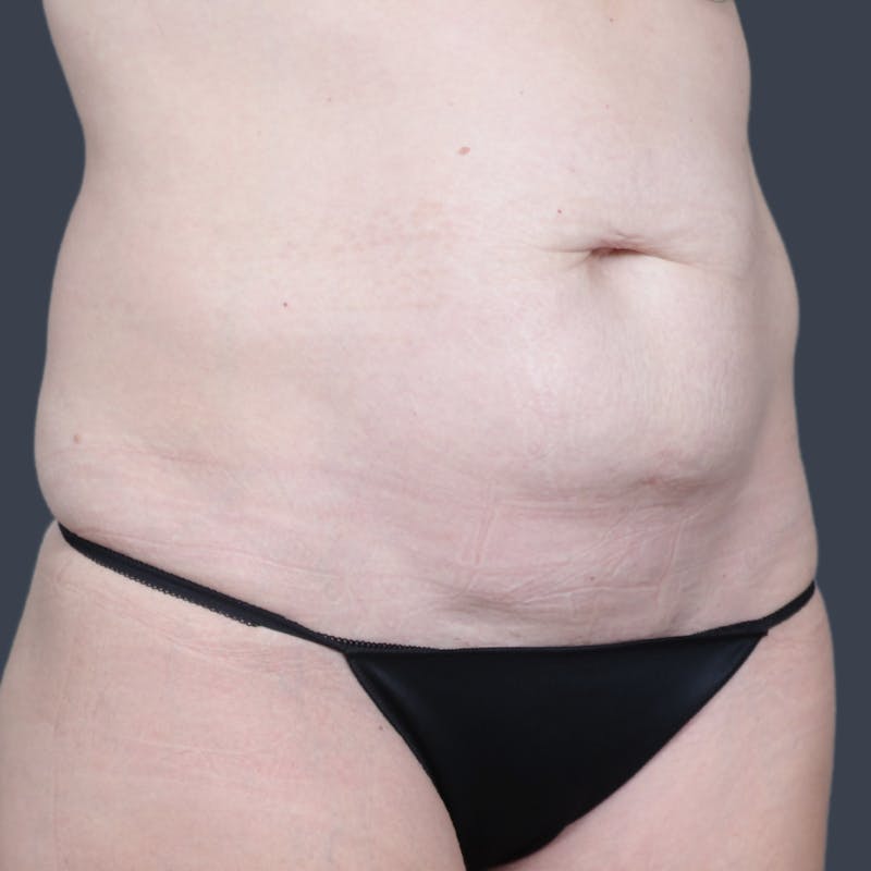 Abdominoplasty / Tummy Tuck Before & After Gallery - Patient 414583 - Image 3