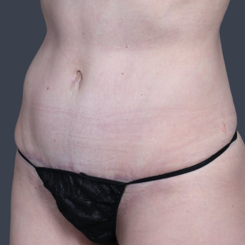 Abdominoplasty / Tummy Tuck Before & After Gallery - Patient 414583 - Image 6