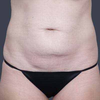 Abdominoplasty / Tummy Tuck Before & After Gallery - Patient 414583 - Image 1
