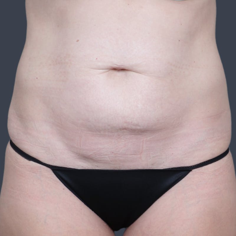Abdominoplasty / Tummy Tuck Before & After Gallery - Patient 414583 - Image 1