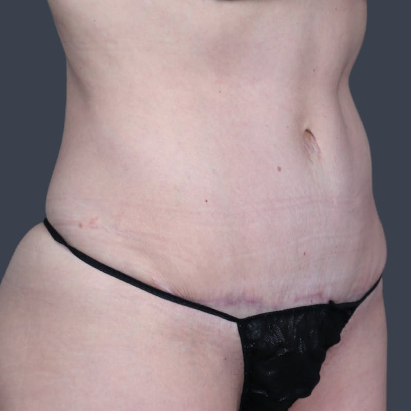 Abdominoplasty / Tummy Tuck Before & After Gallery - Patient 414583 - Image 4