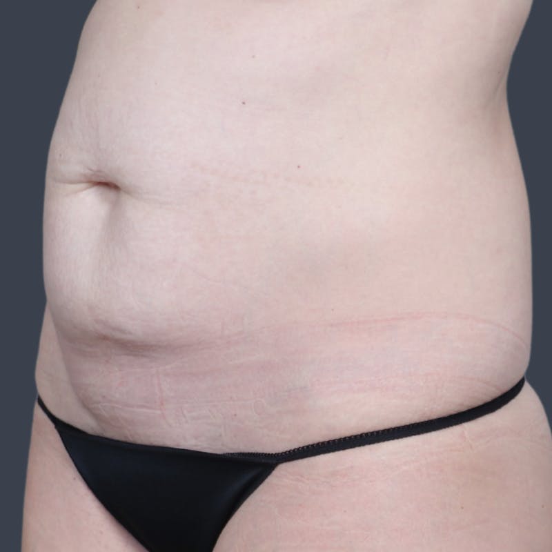 Abdominoplasty / Tummy Tuck Before & After Gallery - Patient 414583 - Image 5
