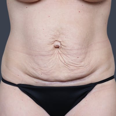 Abdominoplasty / Tummy Tuck Before & After Gallery - Patient 148460 - Image 1