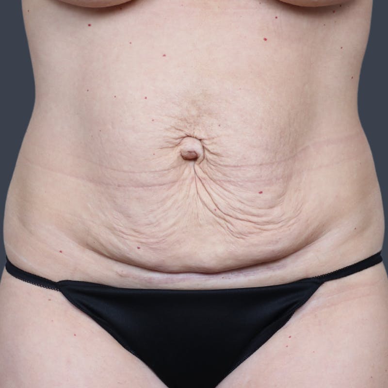 Abdominoplasty / Tummy Tuck Before & After Gallery - Patient 148460 - Image 1