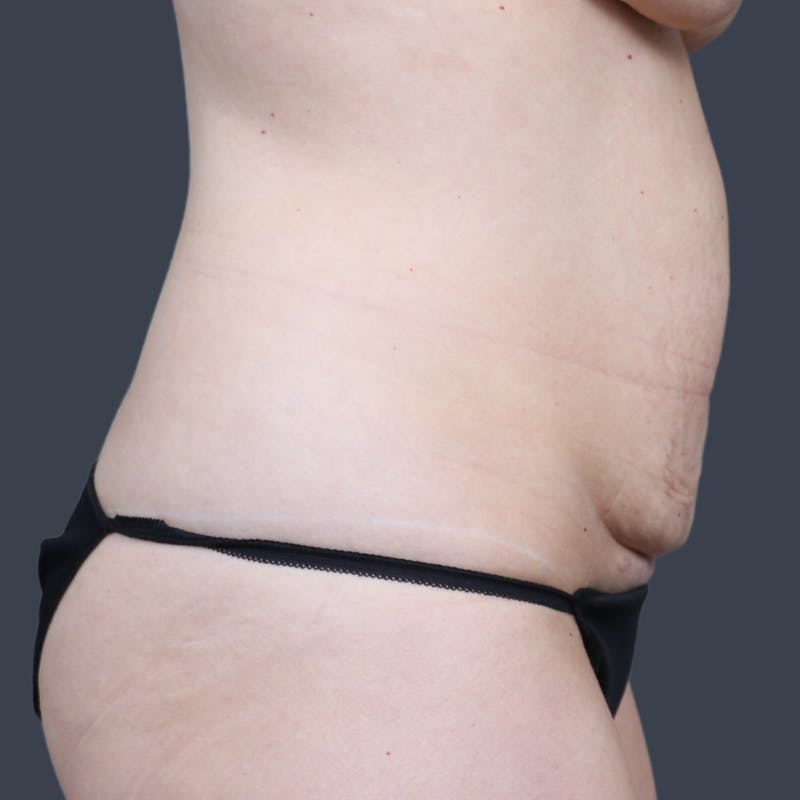 Abdominoplasty / Tummy Tuck Before & After Gallery - Patient 148460 - Image 5
