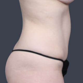 Abdominoplasty / Tummy Tuck Before & After Gallery - Patient 148460 - Image 6