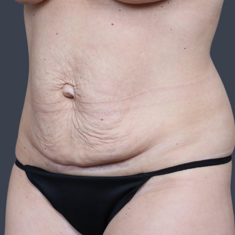 Abdominoplasty / Tummy Tuck Before & After Gallery - Patient 148460 - Image 3