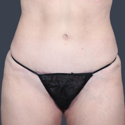 Abdominoplasty / Tummy Tuck Before & After Gallery - Patient 165593 - Image 2