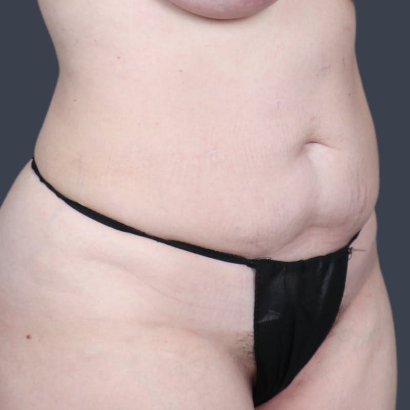 Abdominoplasty / Tummy Tuck Before & After Gallery - Patient 165593 - Image 5