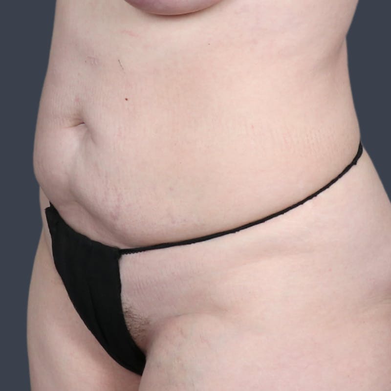 Abdominoplasty / Tummy Tuck Before & After Gallery - Patient 165593 - Image 3
