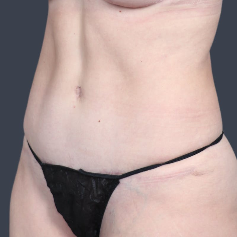 Abdominoplasty / Tummy Tuck Before & After Gallery - Patient 165593 - Image 4