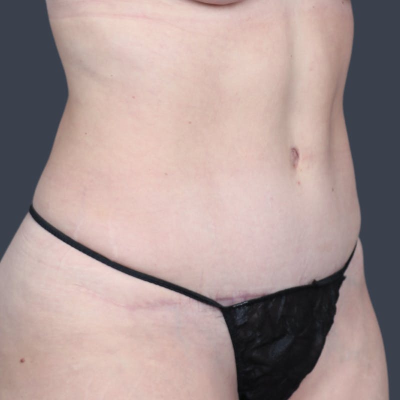 Abdominoplasty / Tummy Tuck Before & After Gallery - Patient 165593 - Image 6