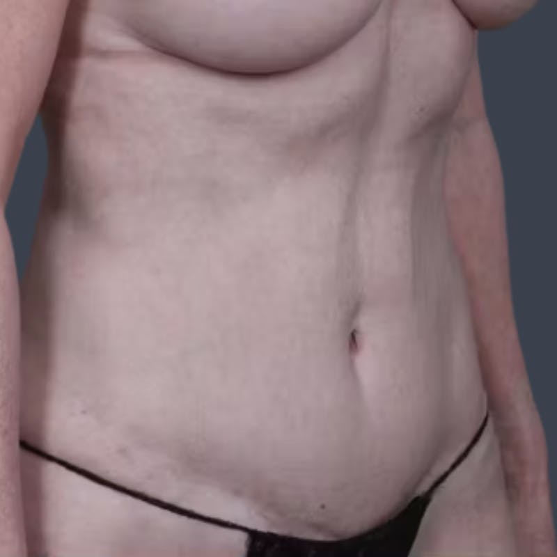 Abdominoplasty / Tummy Tuck Before & After Gallery - Patient 354150 - Image 6